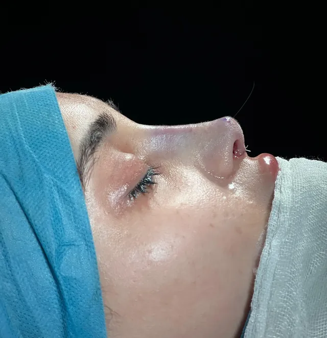 Rhinoplasty - After