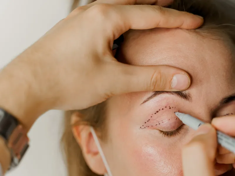 Blepharoplasty