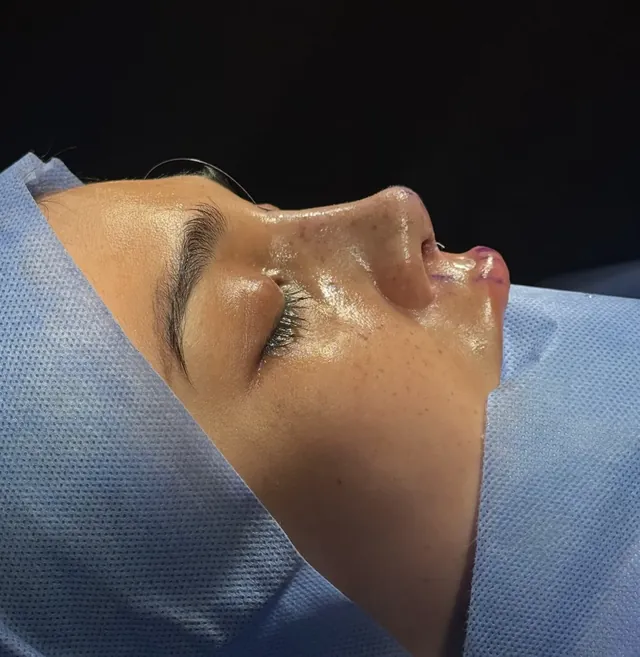 Rhinoplasty - After